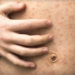 AHS warns of possible measles exposures in Taber, Whitecourt and Grimshaw