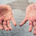 Calgarians being warned about possible exposure to a confirmed case of measles