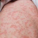 Winnipeg locations among latest measles exposure sites in Manitoba