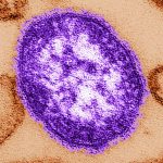 Alberta surpasses 1,000 measles cases, AHS warns of potential exposures in Edmonton