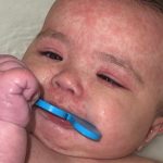 Alberta baby recovering from measles faces ‘long, painful road’