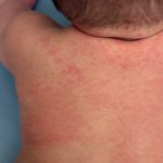 Alberta surpasses all of the United States in confirmed measles cases