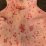 New measles cases detected in B.C.’s Interior, including airports